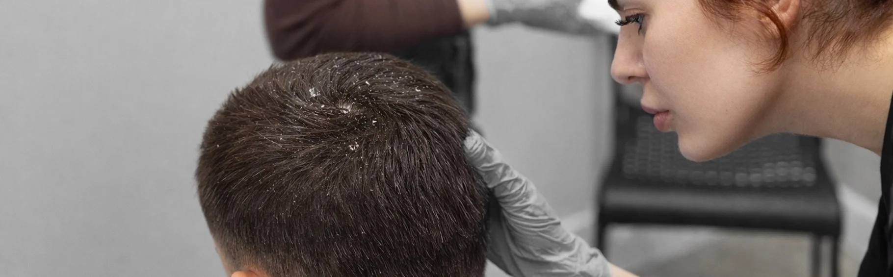 Лечение сухой перхоти