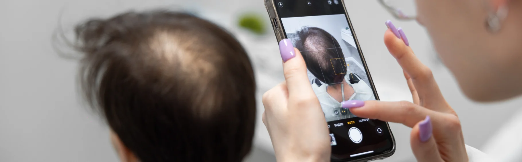 Сильно выпадают волосы (алопеция) — что делать?