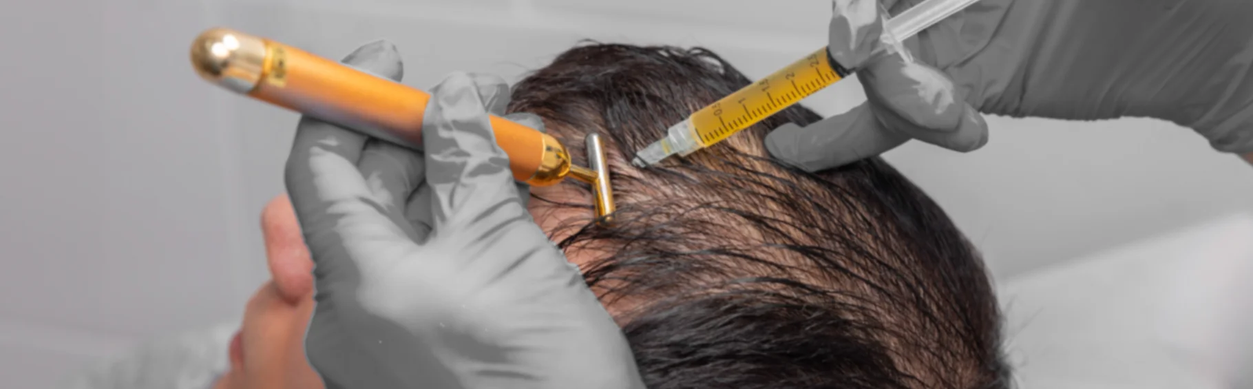 Андрогенная алопеция или выпадение волос по «мужскому типу» — причины и лечение