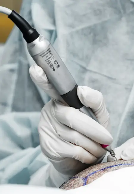 Открытие имплантационных каналов