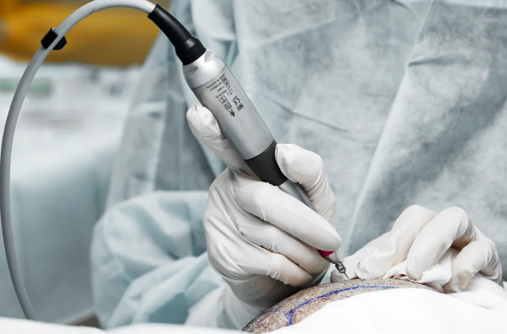 Открытие имплантационных каналов